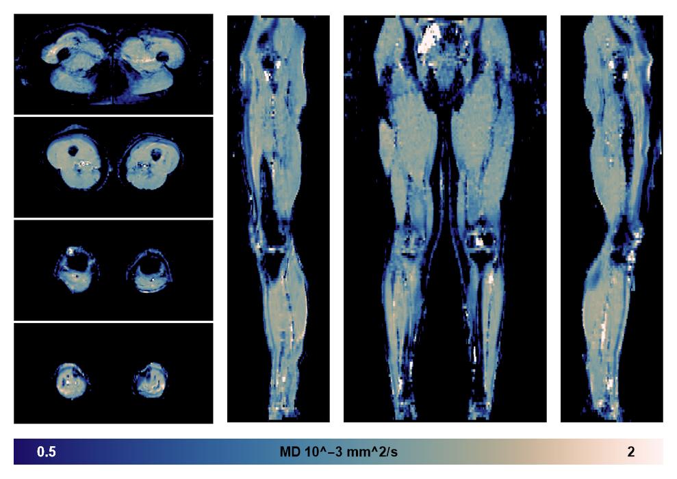 IVIM corrected whole leg muscle mean diffusivity obtained from diffusion tensor imaging.